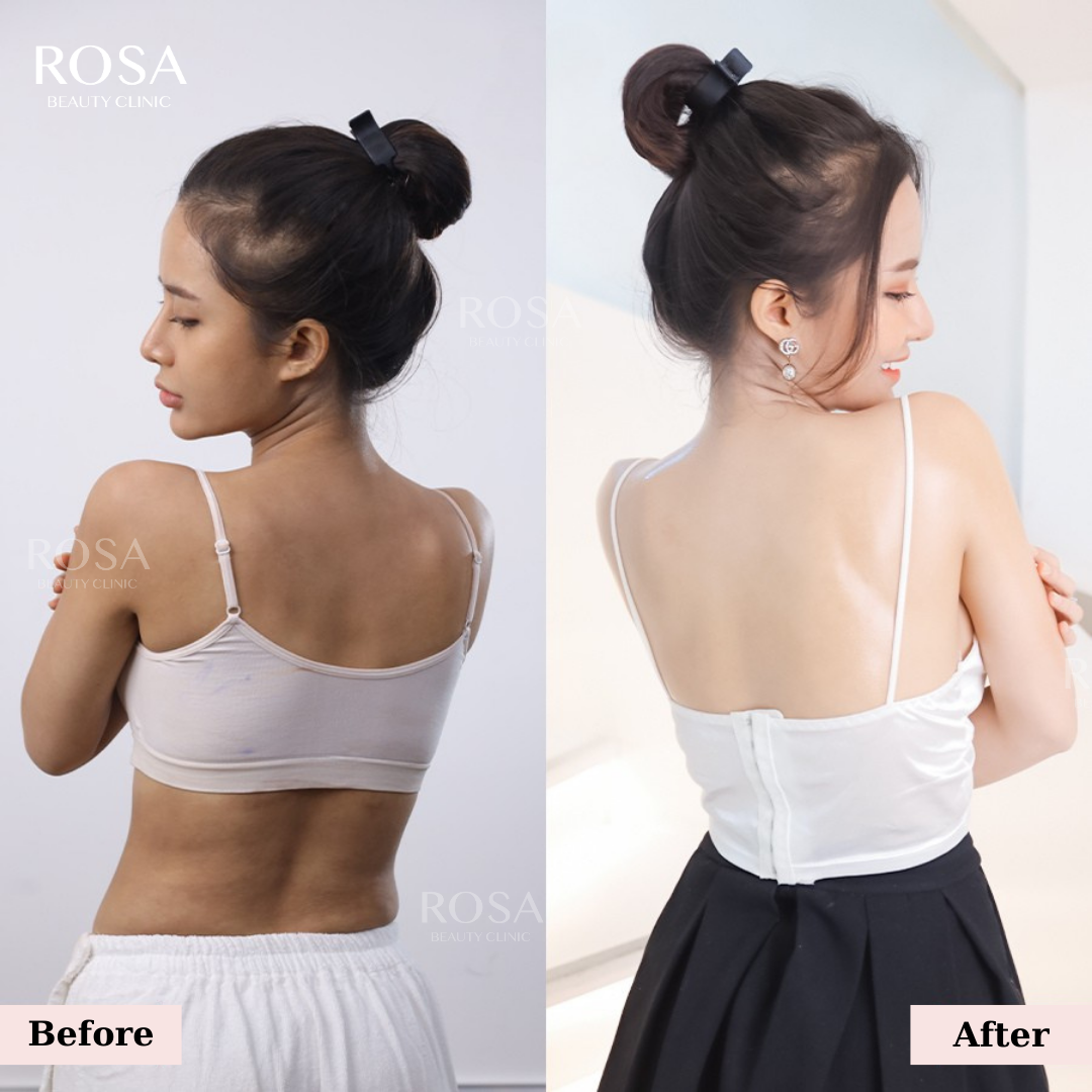 Whitening Treatment