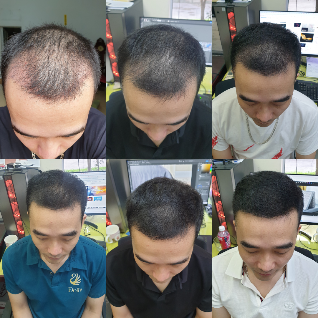 Hair Treatment